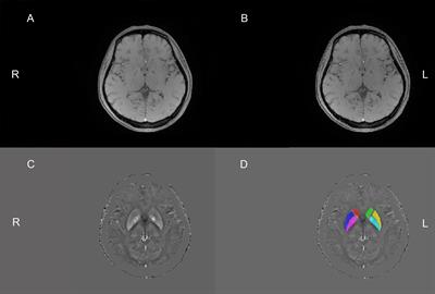 Alterations and Associations Between Magnetic Susceptibility of the Basal Ganglia and Diffusion Properties in Alzheimer’s Disease